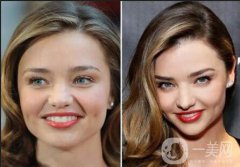 深圳去眼袋填淚溝手術(shù)一共需要多少錢