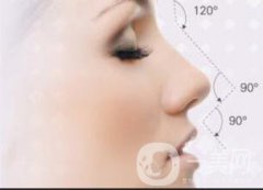 廣東駝峰鼻矯正費(fèi)用大概是多少呢?