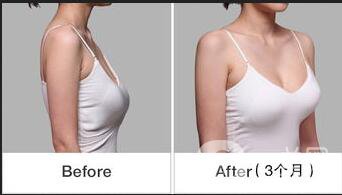 廣東乳房下垂矯正多少錢,乳房下垂矯正多少錢,乳房下垂矯正