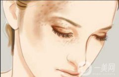 手術(shù)祛痣痛嗎？