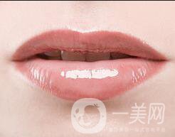 唇腭裂修復(fù)術(shù)后護(hù)理,唇腭裂修復(fù)