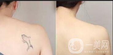 激光洗紋身