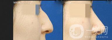 上海鷹鉤鼻矯正價(jià)格,鷹鉤鼻矯正價(jià)格,鷹鉤鼻矯正
