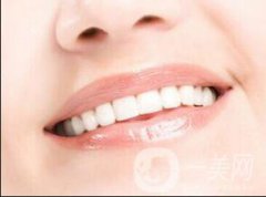 種植牙好不好 種植牙果如何