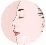 北京駝峰鼻矯正手術費用大概有多少