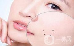 激光祛痣術(shù)后會留疤嗎