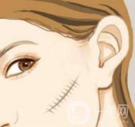 激光祛疤果怎么樣？有什么優(yōu)勢