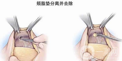 廣東頰脂墊去除價格
