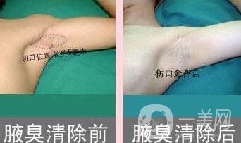 注射去狐臭,注射去狐臭維持時(shí)間