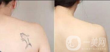 激光洗紋身