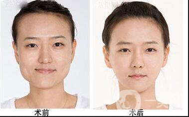 磨下頜角