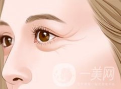 上海自體脂肪去魚尾紋多少錢呢？