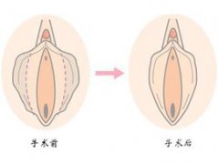陰唇整形不良后果有哪些？
