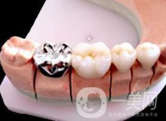 合金烤瓷牙和全瓷牙信息介紹?