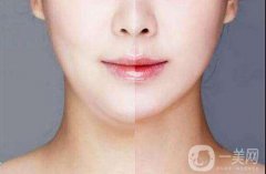 上海臉部抽脂需要多少錢？