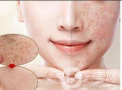 激光去曬斑*果嗎