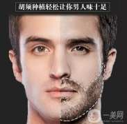 胡須種植注意事項有哪些？