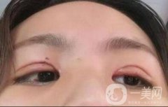 割雙眼皮手術(shù)之后癢怎么辦
