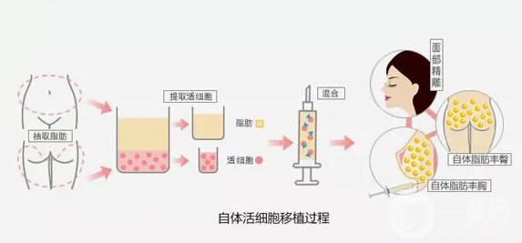 自體隆鼻一般多少錢