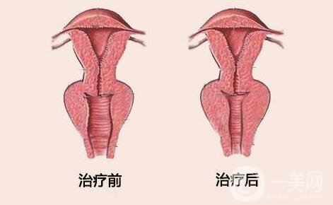 陰道緊縮