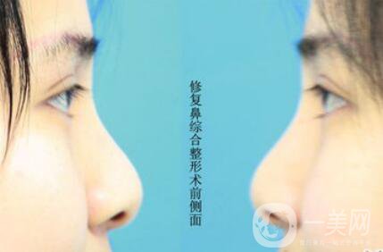 *多久恢復(fù)