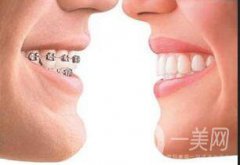 上顎整形報(bào)價(jià)是多少？