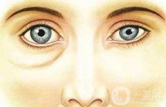 玻尿酸填充淚溝貴不貴呢?價格一般是多少？