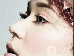 鼻翼縮小手術(shù)價格一般是多少？貴不貴？