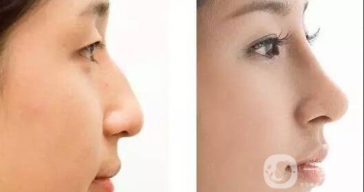 隆鼻多少錢