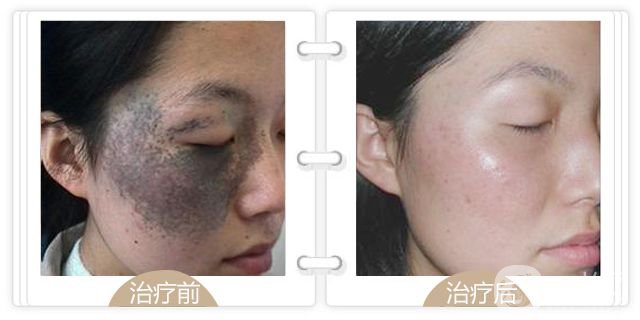 上海去青色胎記多少錢(qián)
