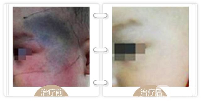上海去青色胎記多少錢(qián)