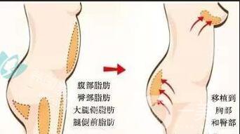 深圳自體脂肪豐臀價格,自體脂肪豐臀價格,自體脂肪豐臀
