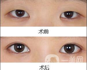 雙眼皮,開眼角,雙眼皮開眼角手術費用