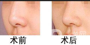 駝峰鼻矯正