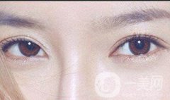 在西安進(jìn)行開眼角手術(shù)的價格是多少呢?