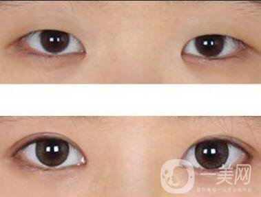 西安開眼角手術價格,開眼角價格