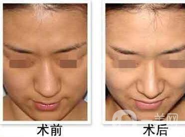 歪鼻矯正手術多久恢復