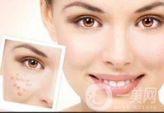 光子嫩膚的優(yōu)勢有哪些