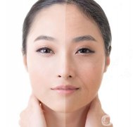 射頻和電波拉皮信息介紹？