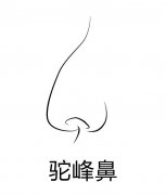 駝峰鼻矯正整形價格是多少？