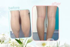 打注射瘦腿要多少錢呢?