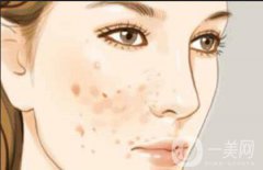 c6激光祛斑貴嗎 術后如何護理