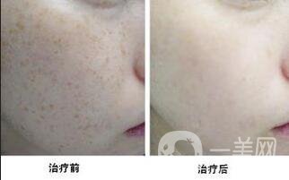 c6激光祛斑貴嗎 術后如何護理