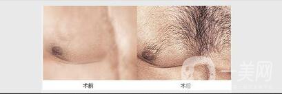 種植胸毛價(jià)格