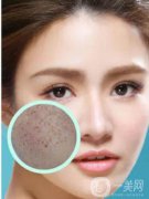 長了黃褐斑怎么辦 光子嫩膚調節(jié)黃褐斑價格是多少？