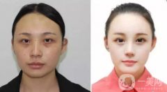 光子嫩膚價(jià)格多少錢 什么是光子嫩膚