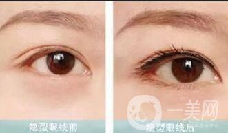 半*美瞳線價格