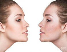 光子嫩膚是什么 價格多少？