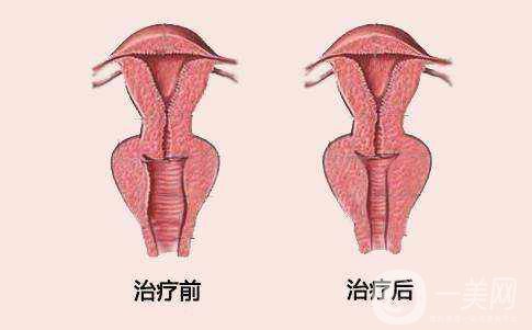陰道緊縮手術(shù)的危害和原理分別是什么