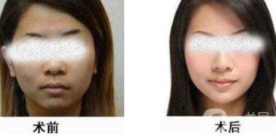 黑臉娃娃縮小毛孔多少錢？